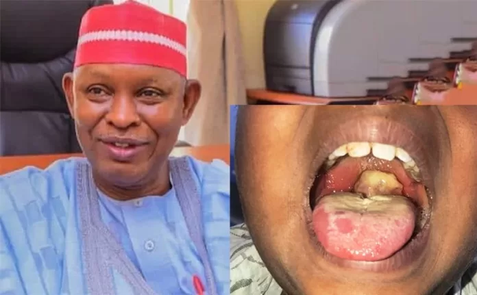 Diphtheria in Kano