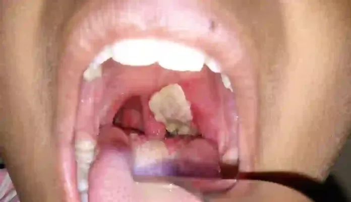 Diphtheria disease Diphtheria disease
